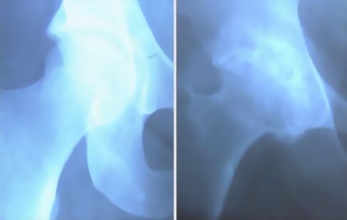 მუხლზე სახსრის ართროზი