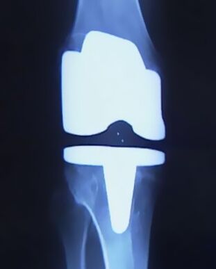 მუხლის X -ray სურათი ხელოვნური პროთეზით, სახსრის შეცვლის ოპერაციის შემდეგ